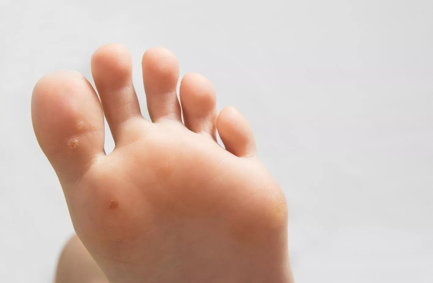 Votre cliente a une verrue…